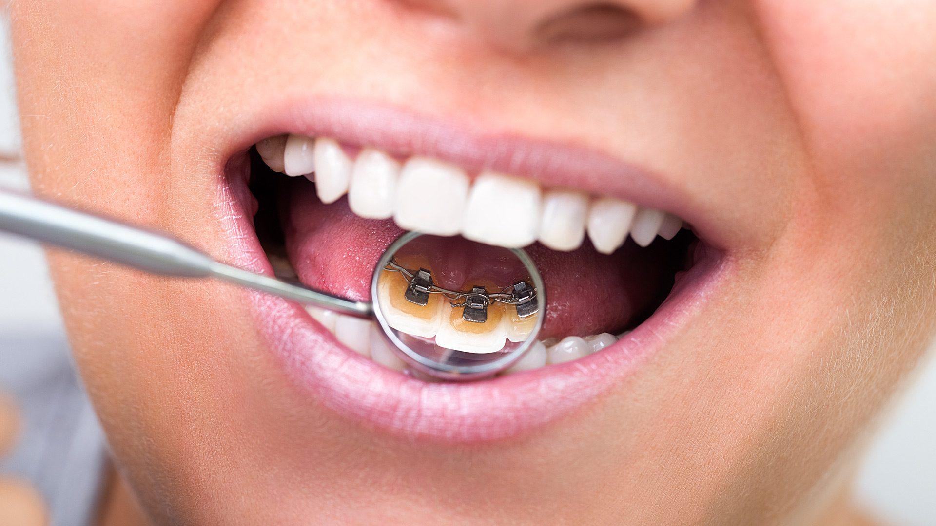 Blanqueamiento Dental